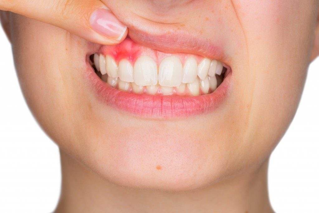 person with bleeding gums