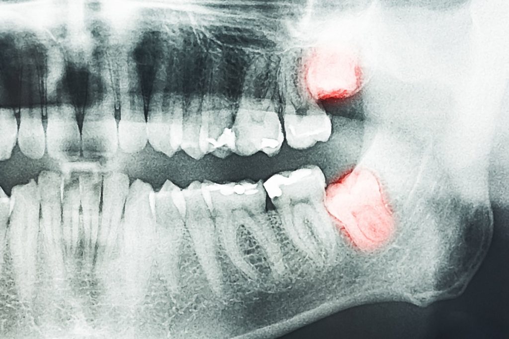 x-ray of a set of teeth